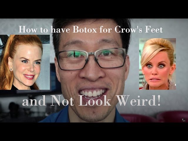 How to have Anti-wrinkle injections to your Crow's Feet without looking Weird!