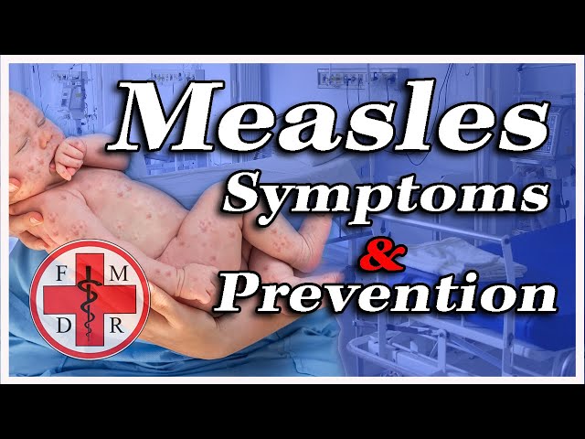 MEASLES SYMPTOMS: What are they and How to PREVENT!