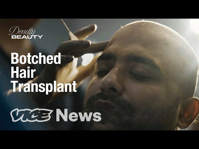 Indian Men Are Risking Lives To Avoid Going Bald | Deadly Beauty