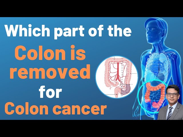 Which Part of the colon is Removed in Colon Cancer Surgery?- Dr. Vinay Samuel Gaikwad #colon #cancer