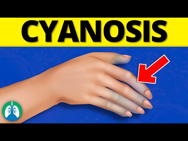 What is Cyanosis? *EXPLAINED*