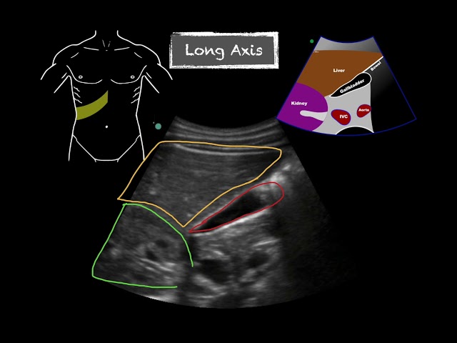 POCUS - Gallbladder Ultrasound Anatomy
