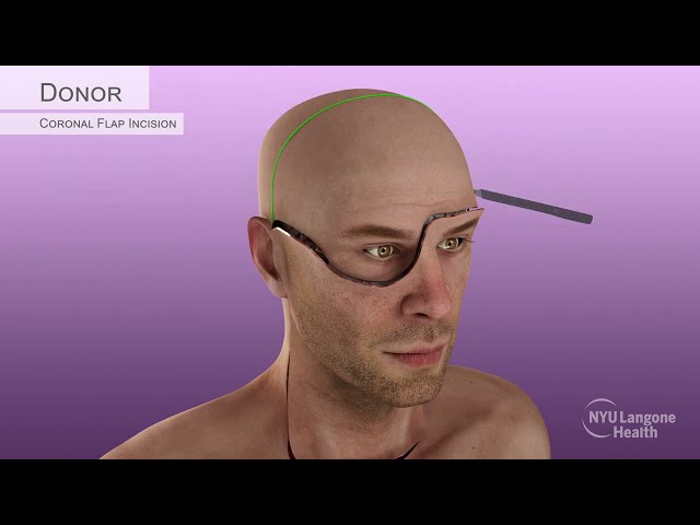 Aaron James's Partial-Face & Total-Eye Transplant Surgical Animation, 2023