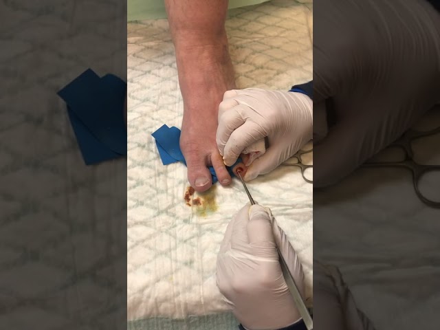 Watch Doctor Remove a Toenail
