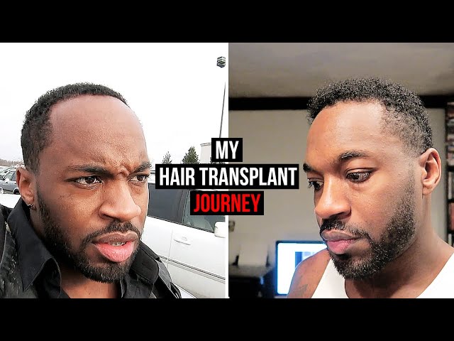 My Hair Transplant Journey | I AM RIO P.