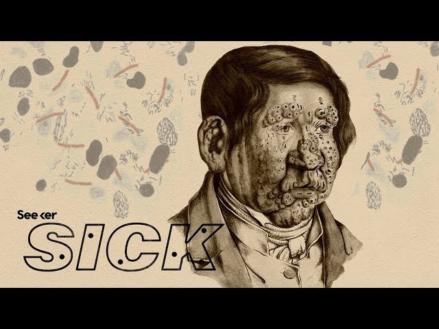 How Does Leprosy Damage the Human Body?
