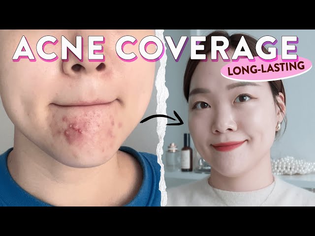 PERFECT LONG-LASTING ACNE COVERAGE TUTORIAL!✨☺️