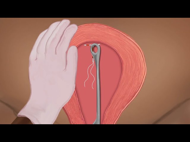 Inserting an IUD Postpartum (Health Workers), Spanish - Family Planning Series