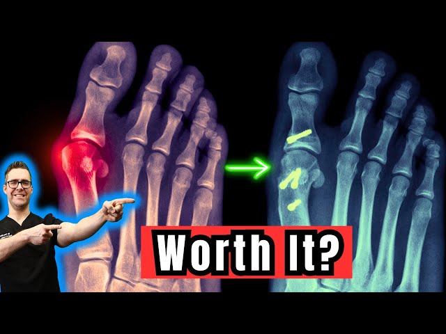 Big Toe Surgery Worth It? [Bunion, Hallux Rigidus & Osteoarthritis]