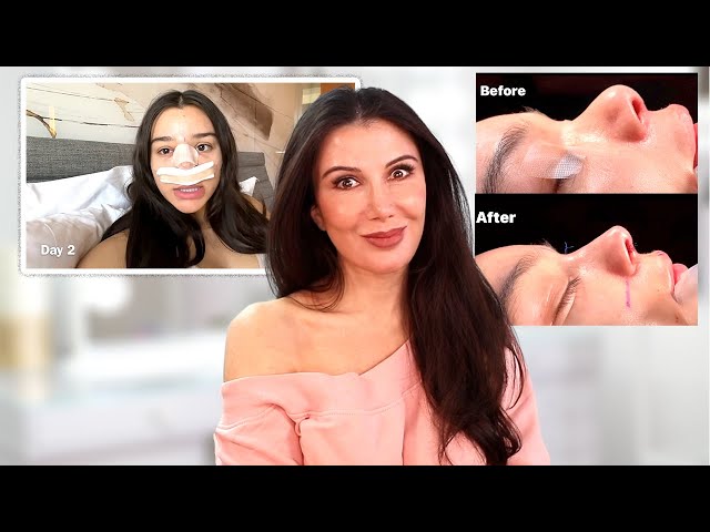 Reacting to Cristina Villegas Nose Update Getting My Cast Removed