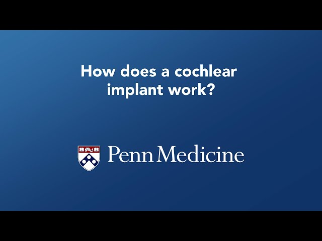 Cochlear Implant – How does a cochlear implant work?