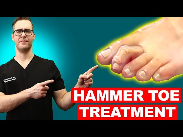 Hammer Toe Exercises, Stretches & Treatment [Claw Toes & Mallet Toes!]