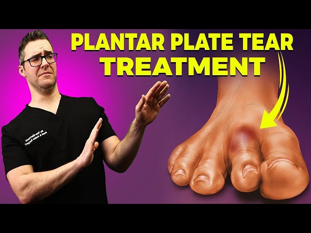 Plantar Plate Tear Treatment [Fix a Torn Plantar Plate]