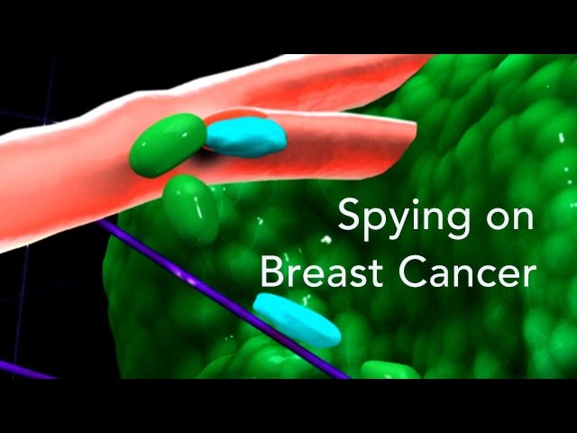 Spying On Breast Cancer Metastasis