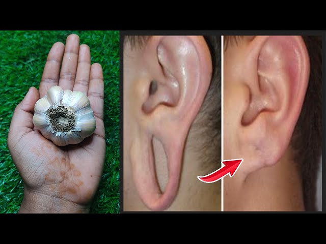 1 பூண்டு போதும் தொங்கிய காது சரியாகிவிடும்|ear hole closing in tamil|earhole closing without surgery