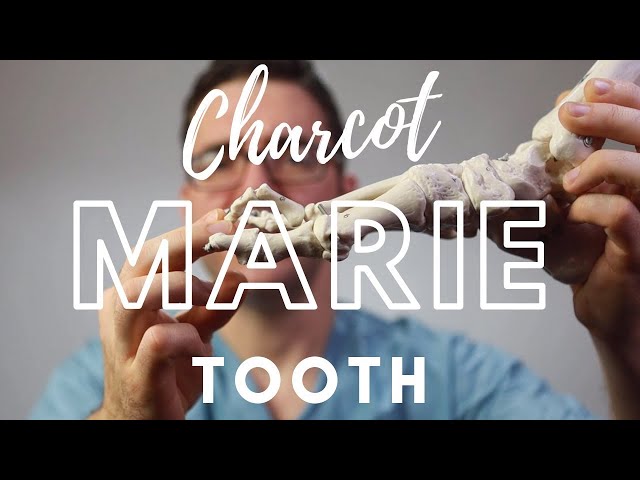 Charcot Marie Tooth Disease [Best Foot Treatment!]