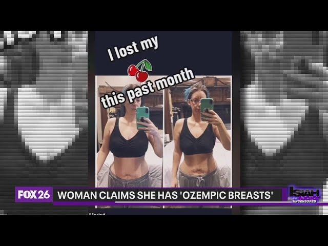 Woman claims 'Ozempic breasts' as side effect of drug
