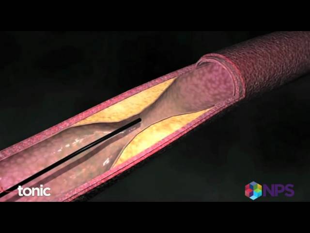 Stents for blocked arteries versus medication and lifestyle changes