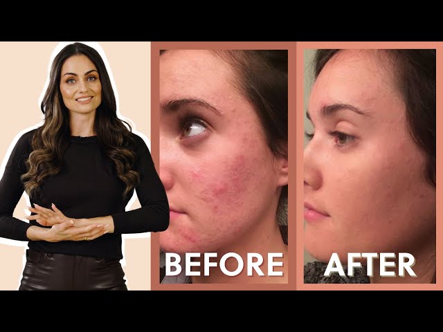 The SECRET Trick to Clearing Acne! | Gut-Skin Connection