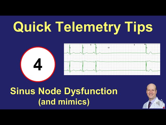Telemetry Tips - Sinus Node Dysfunction
