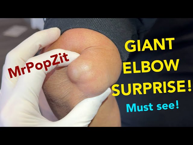 Huge bumpy mass removed from elbow, full of surprises! See 2 week follow up at end.