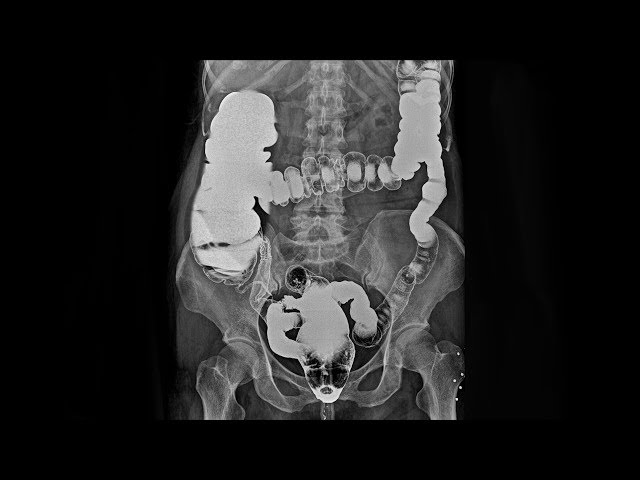 A Lawyer Couldn't Sleep For 9 Days. This Is What Happened To Her Colon.