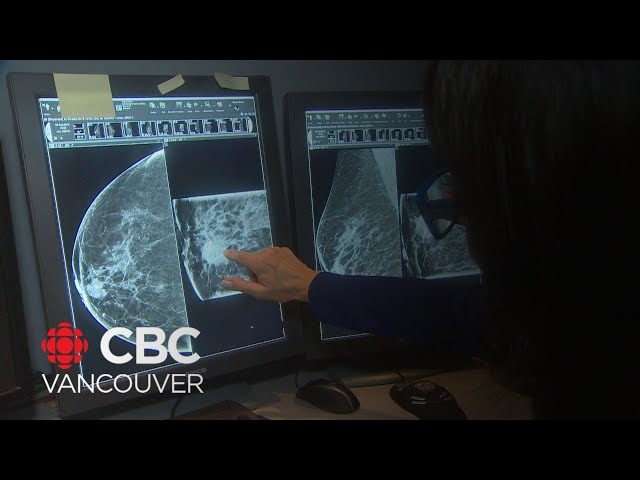 Breast cancer screening wait times in B.C. getting worse, patients and doctors say