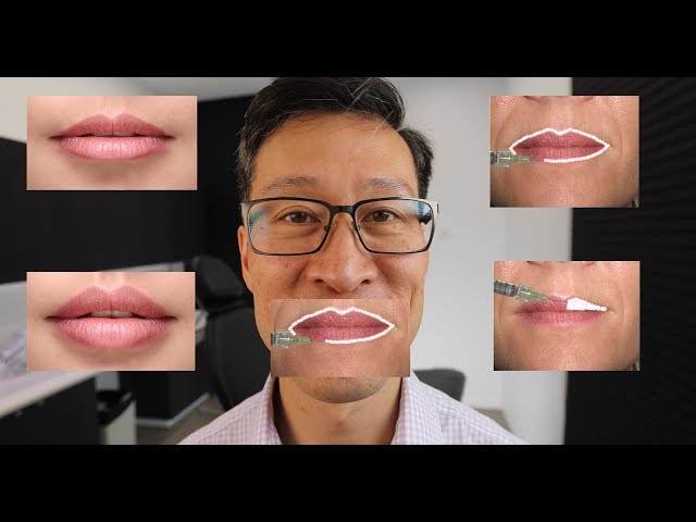 Are BIGGER lips better? The 6 S' of treating lips with dermal filler.