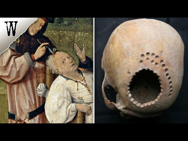 6 Bizarre Facts About ANCIENT BRAIN SURGERY