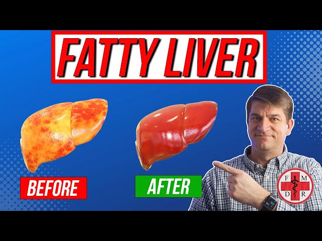 Fix Your Fatty Liver in 6 Simple Steps!