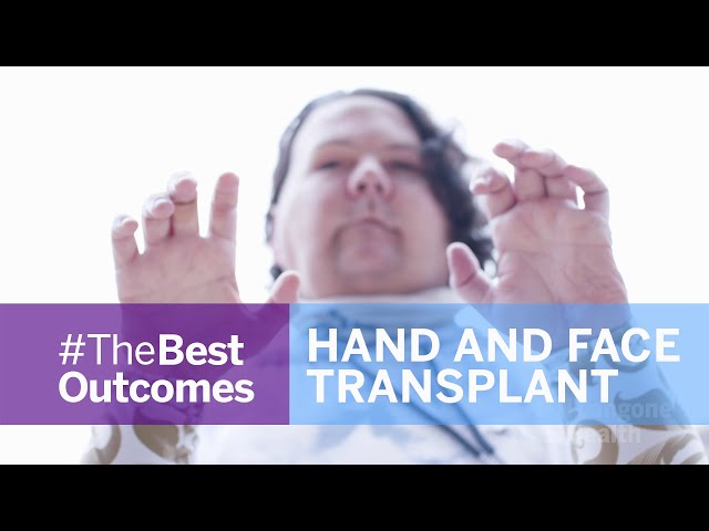 Face and Double Hand Transplant Journey: Joe Dimeo's Story