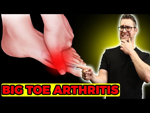 Stiff Big Toe Joint Pain(Hallux Rigidus) TREATMENT [Exercises, Taping]