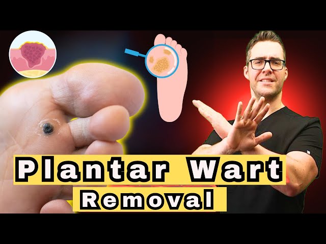 How To Get Rid of the MOST STUBBORN Plantar Warts! [2024 Update]