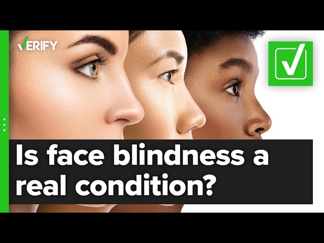 VERIFY: Yes, face blindness is a real condition