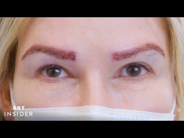 Eyebrow Transplants Restore Brows With Real Hair