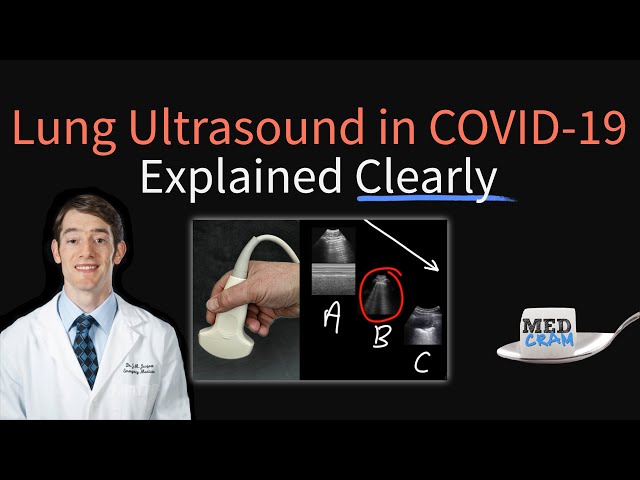 Lung Ultrasound in COVID 19: Findings, Accuracy, Pneumonia Diagnosis, Utility (POCUS)