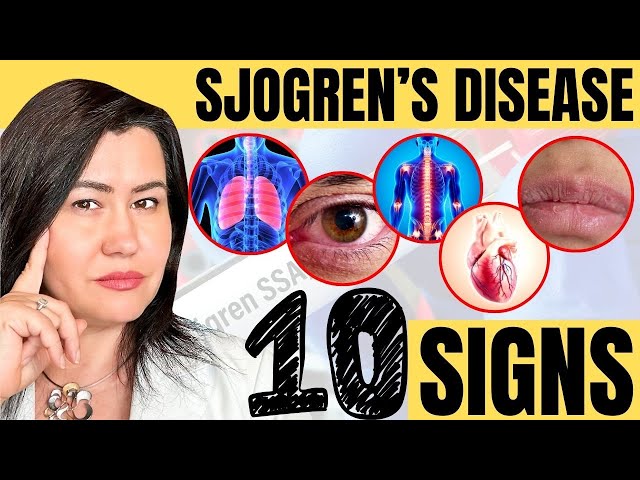 10 Signs of Sjogren's Syndrome - a very complex autoimmune disease