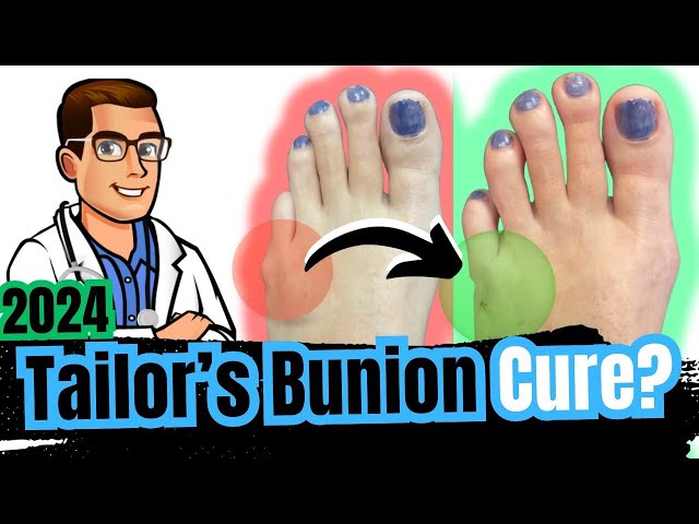 Bunionette Tailor's Bunion Surgery? [Corrector, Splints & Treatment]