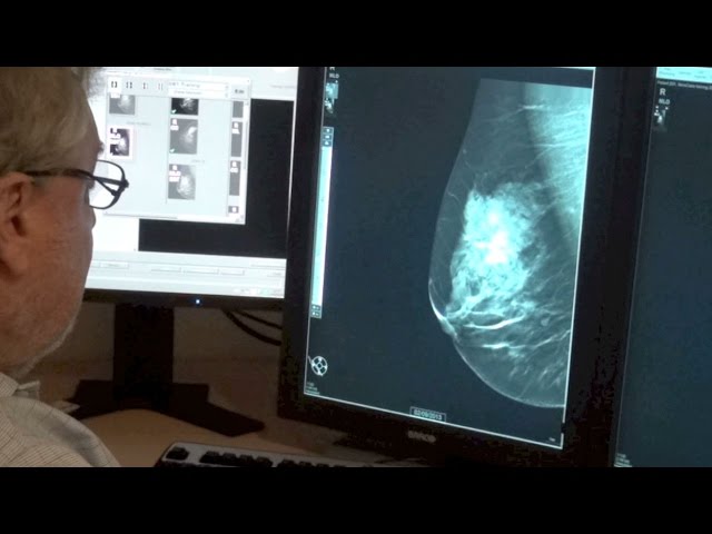Do 3-D mammograms improve breast cancer screening?