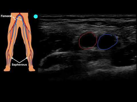 Ultrasound Guided Venous Access