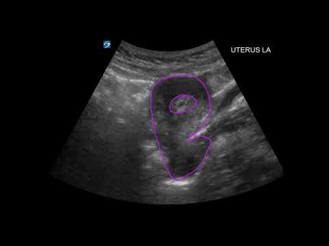 First Trimester Pregnancy Ultrasound
