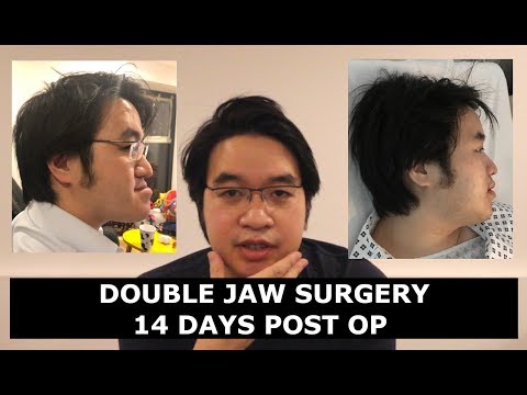 Double Jaw Surgery Recovery Experience (old channel)
