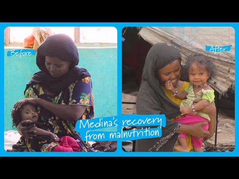 Before and After: Severe Malnutrition Recovery Stories