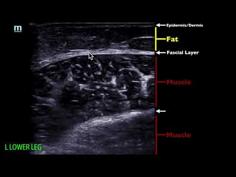 Soft Tissue Ultrasound