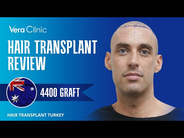 Vera Clinic Hair Transplant Istanbul Review 4400 Grafts #hairtransplant #hairtransplantturkey