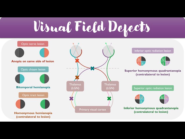Visual Field Defects Explained | Visual Pathways