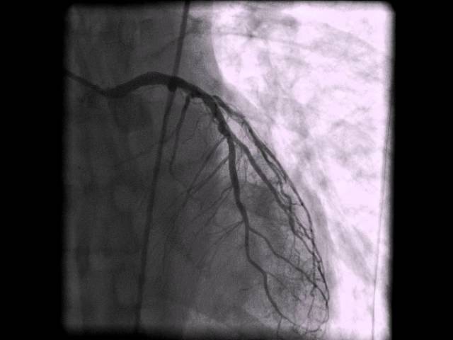 Left Coronary Artery Angiogram 100