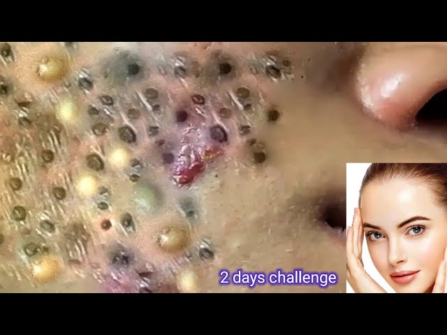 blackheads,acne,wrinkle treatment at home|pimple removal facial|how to reduce acne,pimple,blackheads