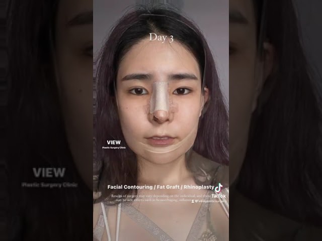 We are doing our best to upgrade your beauty🥰  #viewplasticsurgery #korean