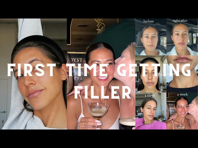 I GET FILLER FOR THE FIRST TIME